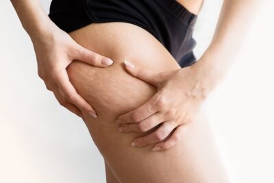 Cellulite