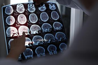 alzheimer
