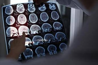 alzheimer