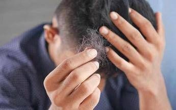 alopecia
